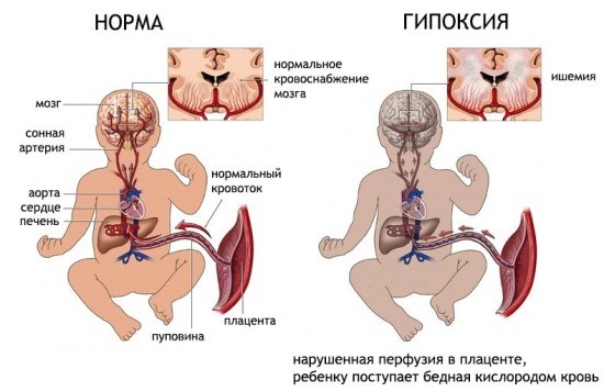 Норма и гипоксия