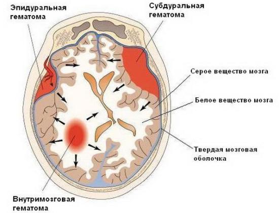 Эпидуральная, субдуральная и внутримозговая гематомы