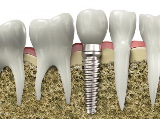 Зубной имплант не смещается под воздействием МРТ