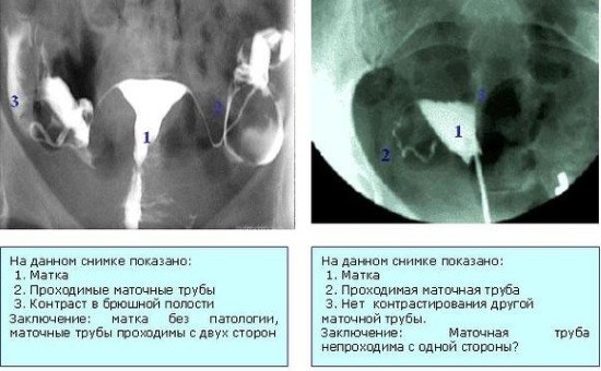 Рентгенограммы матки и труб