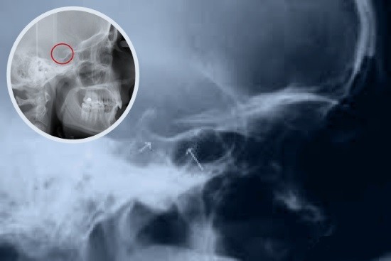 Рентгеновский снимок турецкого седла