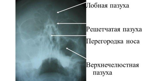 Рентгенограмма придаточных пазух носа
