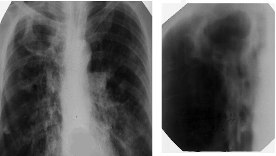 Обзорная рентгенограмма грудной клетки при туберкулезе