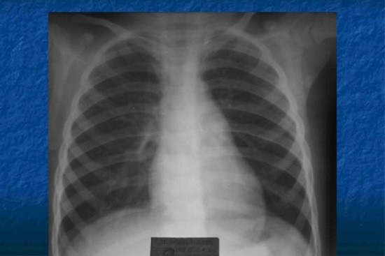 Пример рентгеновского снимка легких