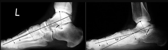 Угол между первой плюсневой и таранной костью в норме и при плоскостопии