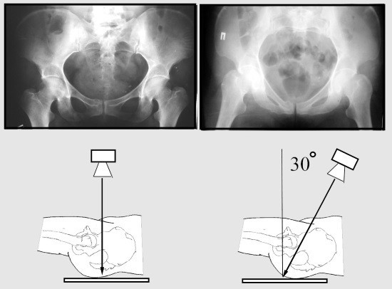 Укладки для рентгенографии костей таза