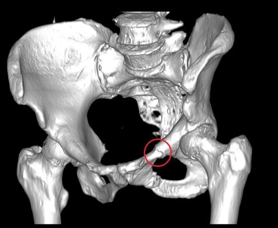 Перелом левой лонной кости в стадии неполной консолидации