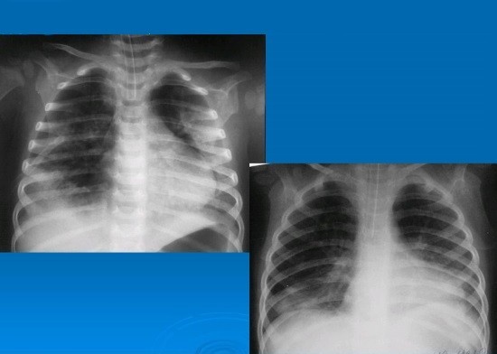 Рентгенография грудной клетки при пневмотораксе