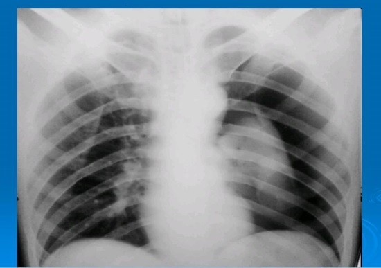 Пневмоторакс на рентгенограмме