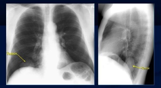 Рентгенограммы при периферическом раке легких