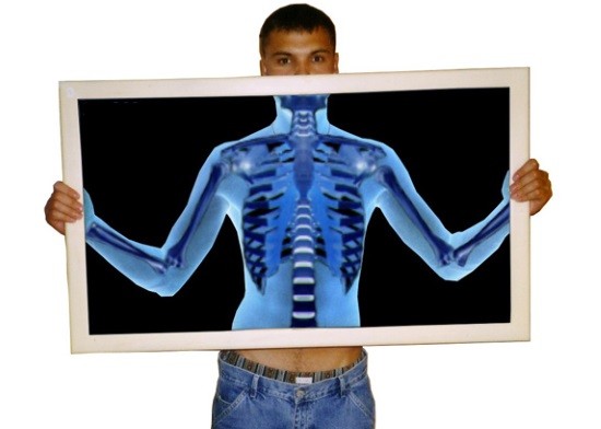 Рентген широко используют для выявления переломов, трещин и других патологий костей
