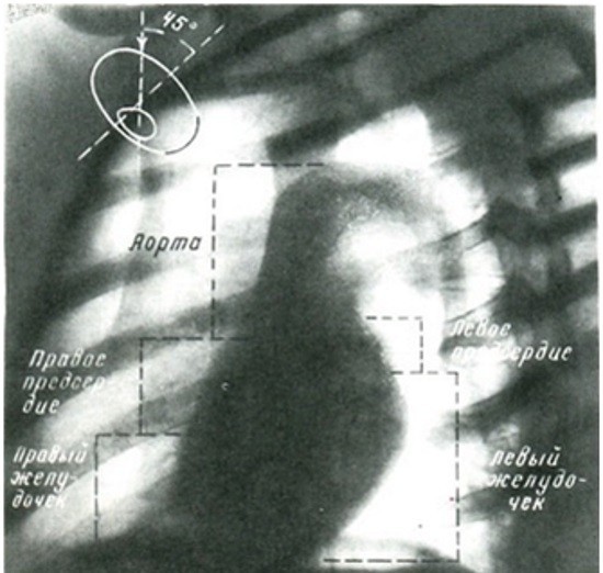Рентгенография в проекции по Л. Д. Линденбратену