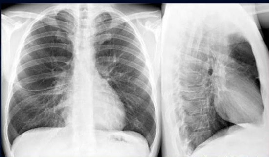 На рентгенограмме крупные скопления воздуха – буллы