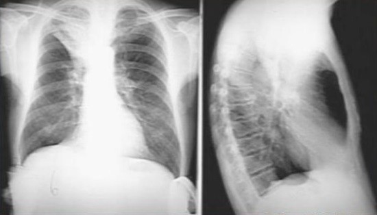 Рентгенограмма легких при ателектазе
