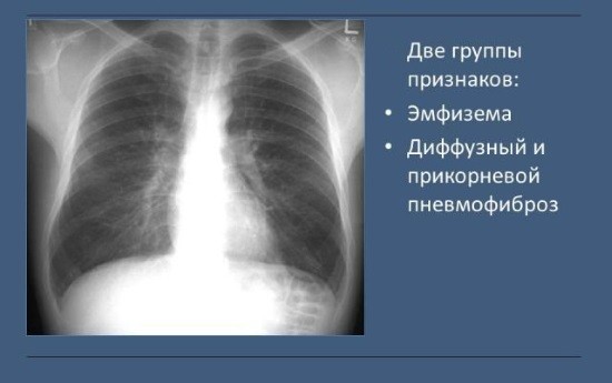 Рентгенологические признаки хронического бронхита