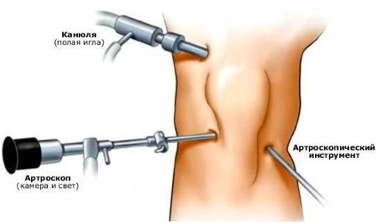 Артроскопия коленного сустава осуществляется через микроразрезы кожи в области колена