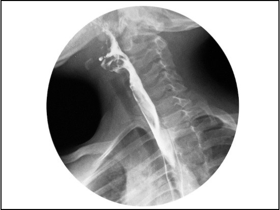 Рентгеноскопия пищевода – способ диагностики многих его патологий