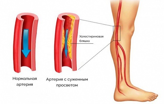 Атеросклероз сосудов нижних конечностей