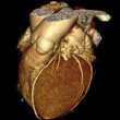 МСКТ в диагностике сосудов сердца – метод, способный предупредить ишемическую болезнь