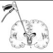 Эндоскопия при заболеваниях головного мозга: преимущества, показания и подготовка