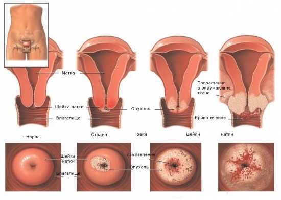 Рак шийки матки та ендометрія на УЗД » журнал здоров'я iHealth 2