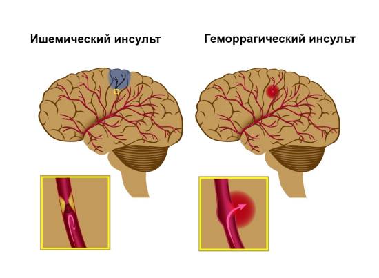 Як проходить МРТ головного мозку, скільки триває? » журнал здоров'я iHealth 