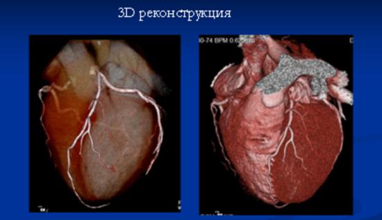 Комп'ютерна томографія (КТ) серця і коронарних судин » журнал здоров'я iHealth 1