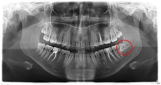 Панорамна рентгенографія щелеп (зубів): показання, проведення, результати » журнал здоров'я iHealth 1