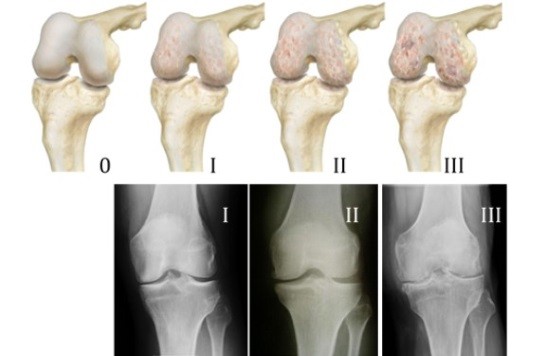 Рентген колінного суглоба – що показує знімок? » журнал здоров'я iHealth 2