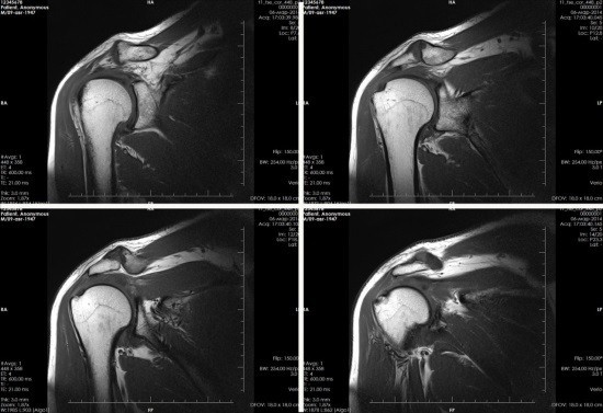 Рентген плечового суглоба: показання, проведення, результати » журнал здоров'я iHealth 3
