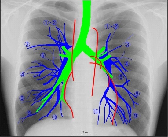 Сегменти легень на рентгенограмі: будова, топографія, патології » журнал здоров'я iHealth 2