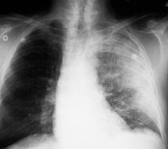 Darkening in the lungs on xray what can it be?