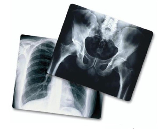 Як часто і скільки разів можна робити рентген? » журнал здоров'я iHealth 