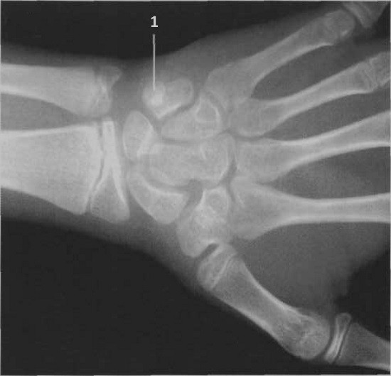 Рентген кисті руки: показання, проведення, опис і результати » журнал здоров'я iHealth 2