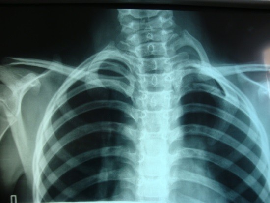Рентген ребер: показання, підготовка, проведення, результати » журнал здоров'я iHealth 
