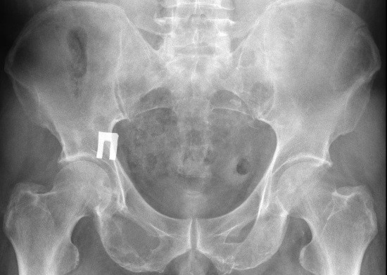 Рентген (рентгенографія) кісток тазу: підготовка, проведення, результати » журнал здоров'я iHealth 