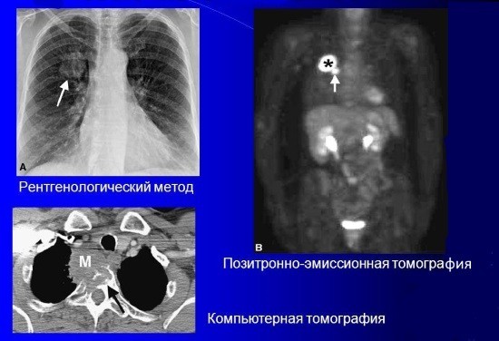 Рентген при раку легень: що показує рентгенограма? » журнал здоров'я iHealth 1