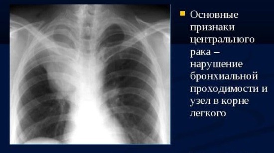 Рентген при раку легень: що показує рентгенограма? » журнал здоров'я iHealth 3