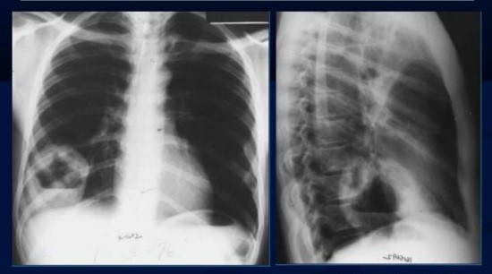 Рентген при раку легень: що показує рентгенограма? » журнал здоров'я iHealth 5