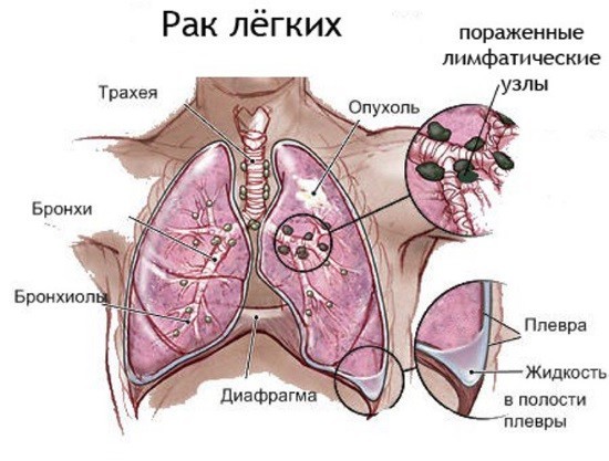 Рентген при раку легень: що показує рентгенограма? » журнал здоров'я iHealth 
