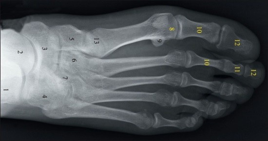 Рентген (рентгенографія) стопи: як роблять, знімок норми, результати » журнал здоров'я iHealth 