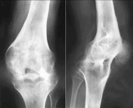 Рентген суглобів: показання, підготовка, результати » журнал здоров'я iHealth 2