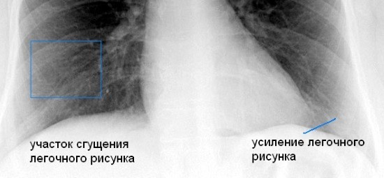 Посилення легеневого малюнка на рентгені – що це? » журнал здоров'я iHealth 