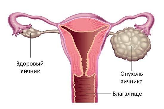 Лапароскопія маткових труб: підготовка, проведення, відновлення » журнал здоров'я iHealth 3