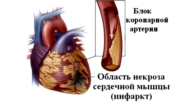 Так выглядит участок некроза сердечной мышцы