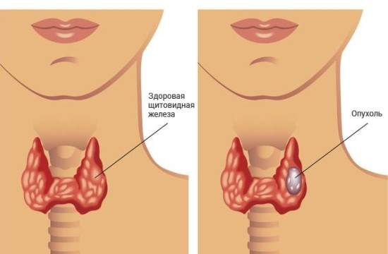 Опухоль щитовидки
