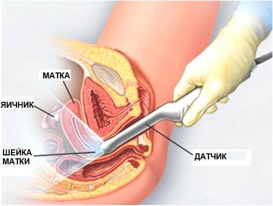 Проведение ультразвукового исследования через вагину