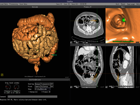 Компьютерная томография кишечника