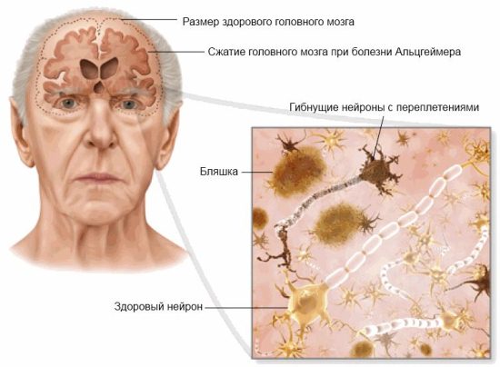 Сенильная деменция альцгеймеровского типа