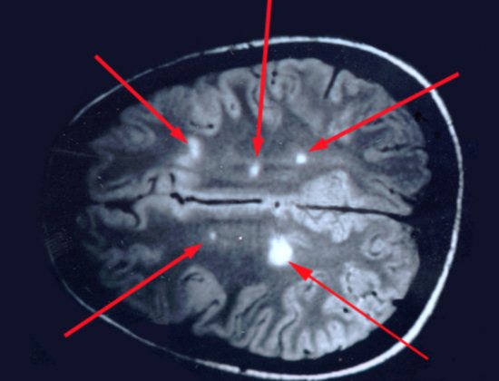 Магнитно-резонансная томография головного мозга при рассеянном склерозе